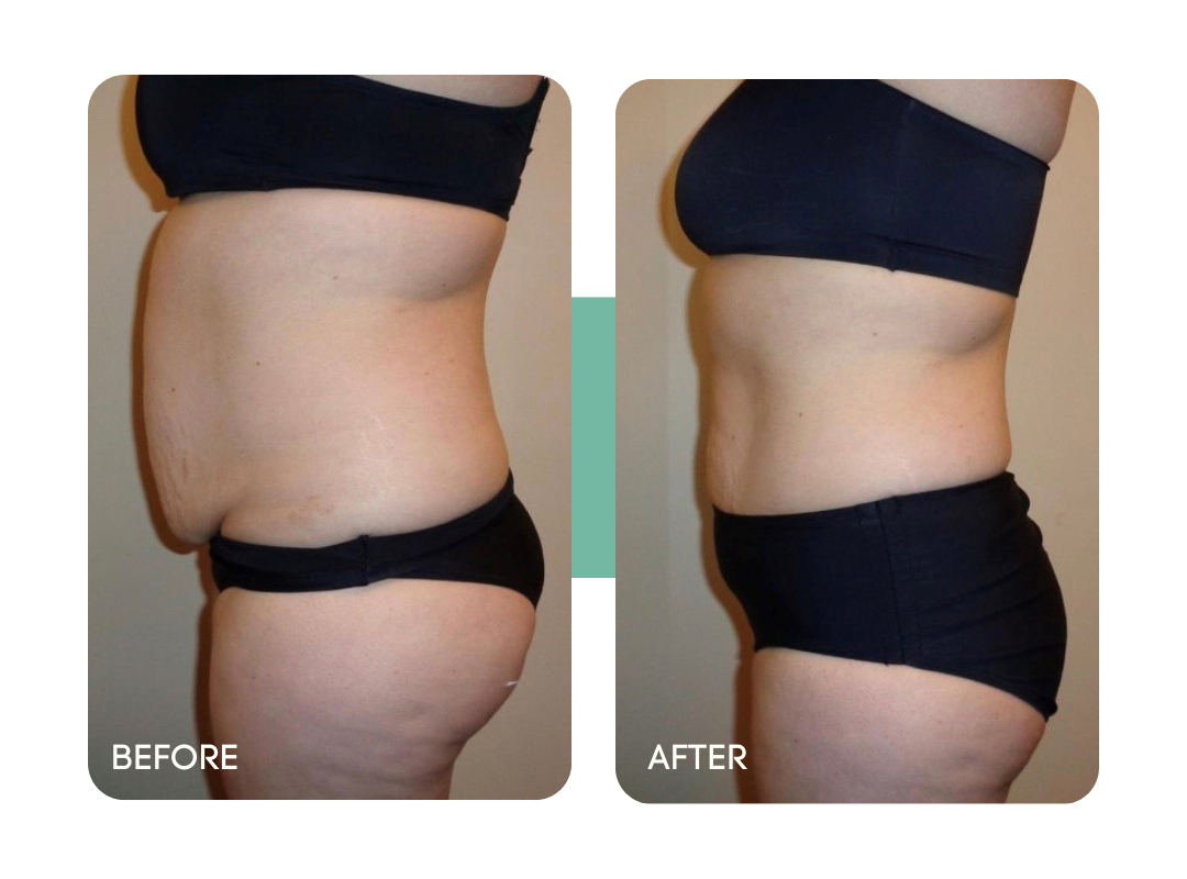 Zerona Before After7