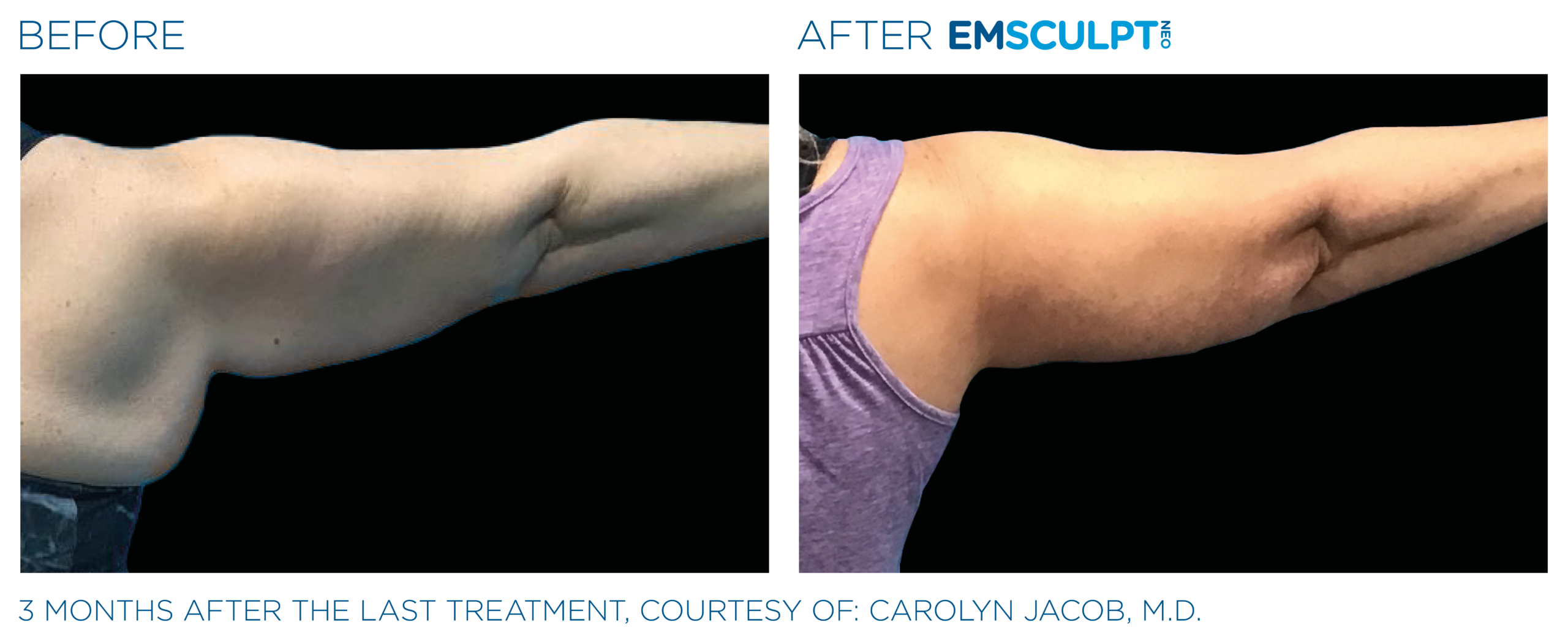 Emsculpt_Neo_PIC_Ba-card-female-arms-078_ENUS100