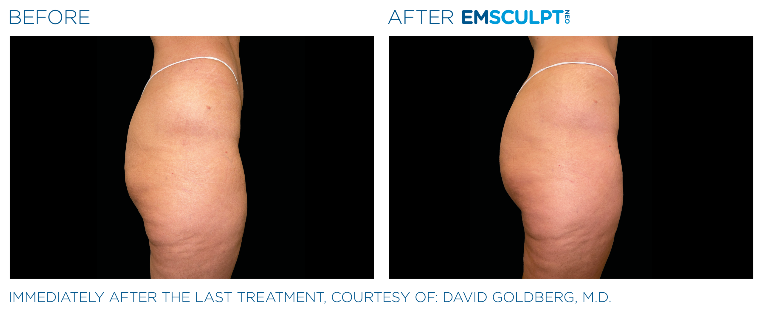Emsculpt_Neo_PIC_Ba-card-female-buttock-073_ENUS100