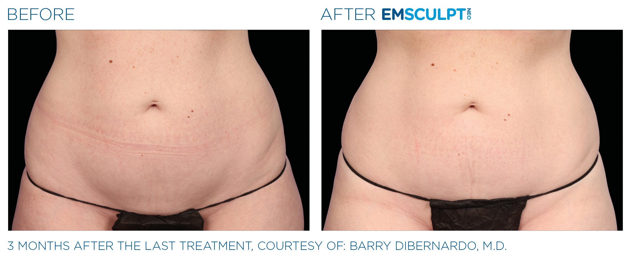 Emsculpt_Neo_PIC_Ba-card-female-lateral-abdomen-141_ENUS100