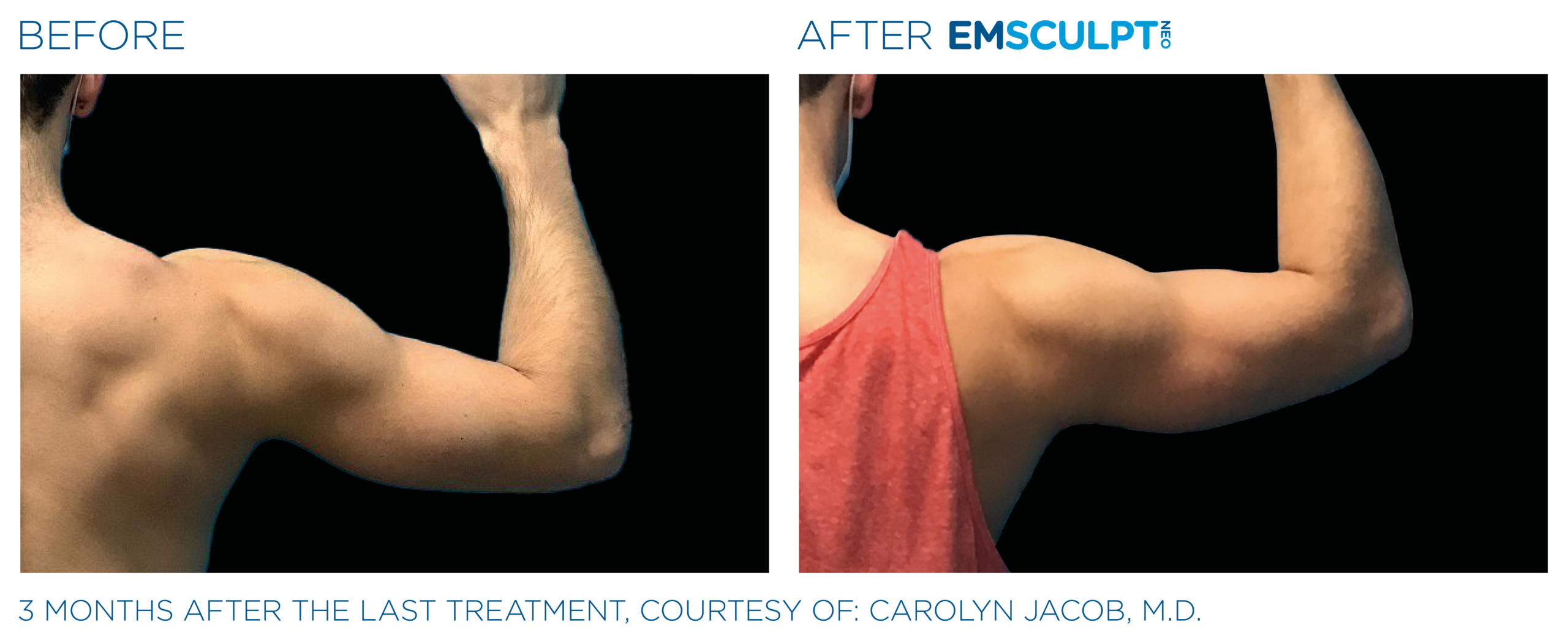 Emsculpt_Neo_PIC_Ba-card-male-arms-077_ENUS100