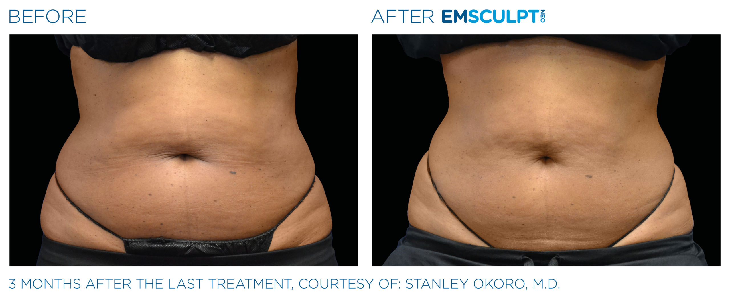 Emsculpt_Neo_PIC_Ba-card-male-lateral-abdomen-167_ENUS100
