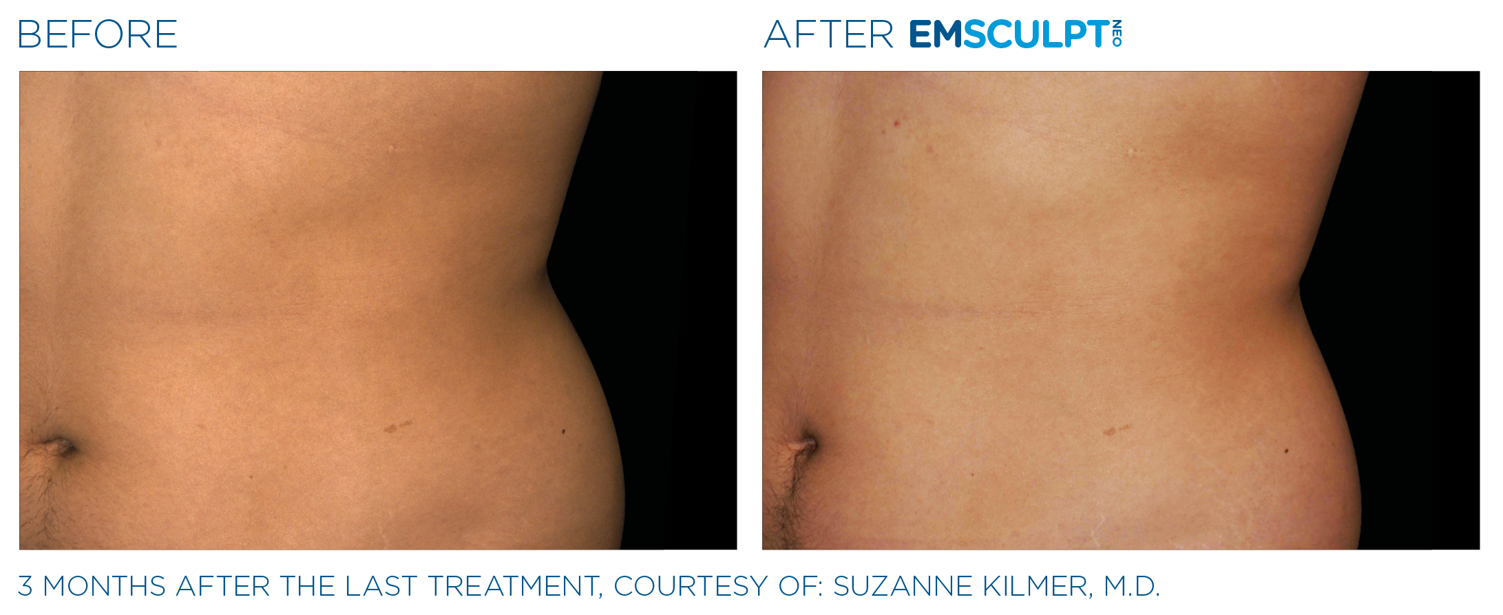 Emsculpt_Neo_PIC_Ba-card-male-lateral-abdomen-177_ENUS100