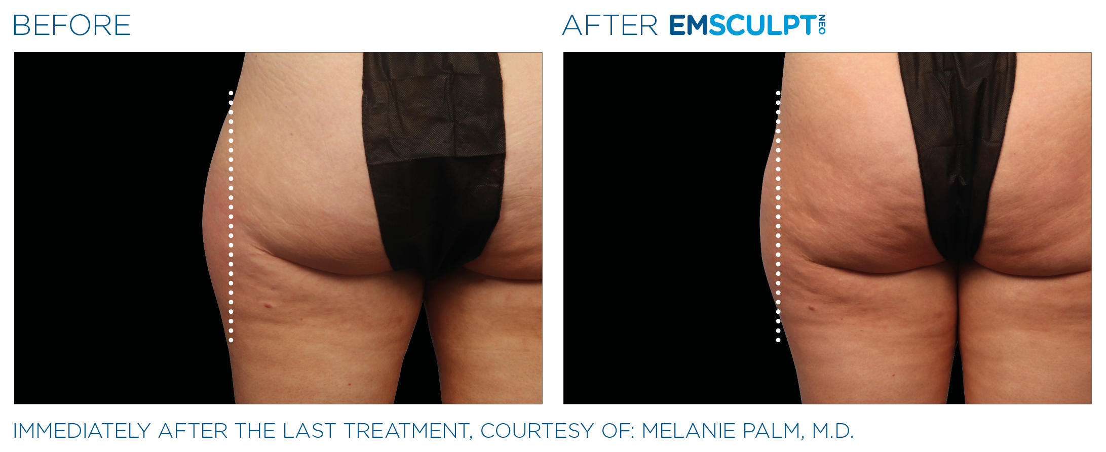 Emsculpt_neo_PIC_Ba-card-female-outer_thighs-053_ENUS100